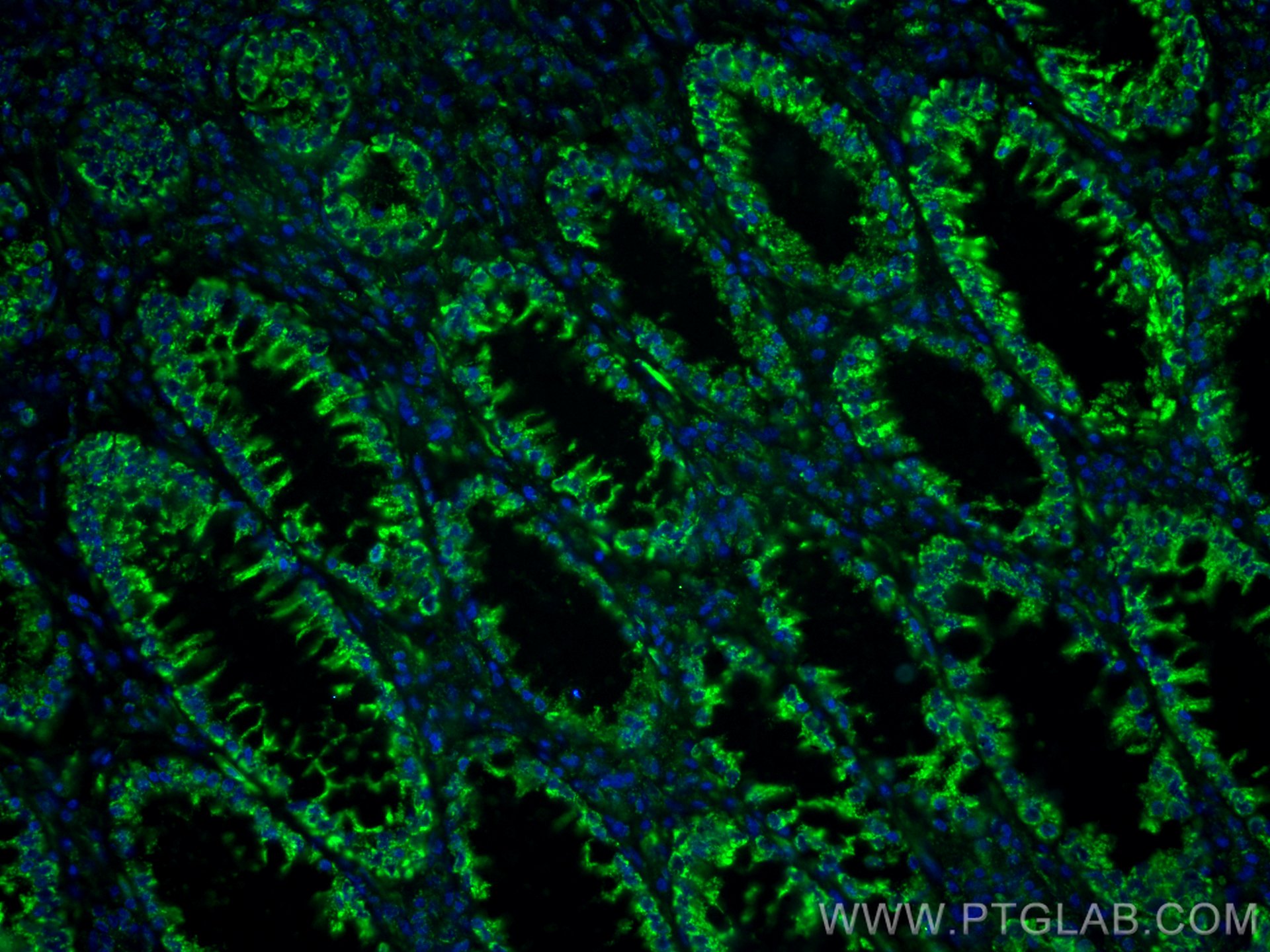 IF Staining of human colon cancer using 66869-1-Ig