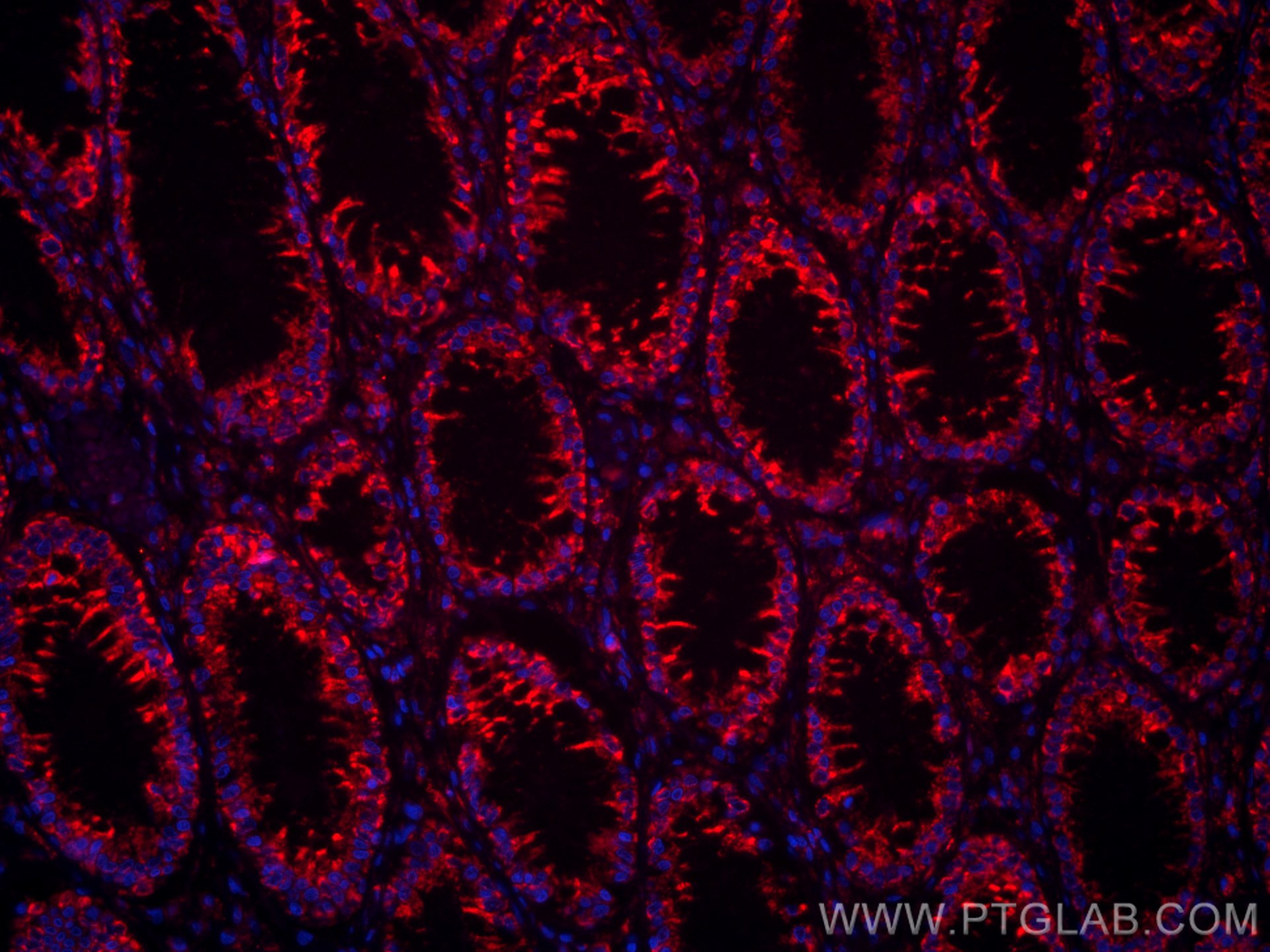 IF Staining of human colon cancer using CL594-66869