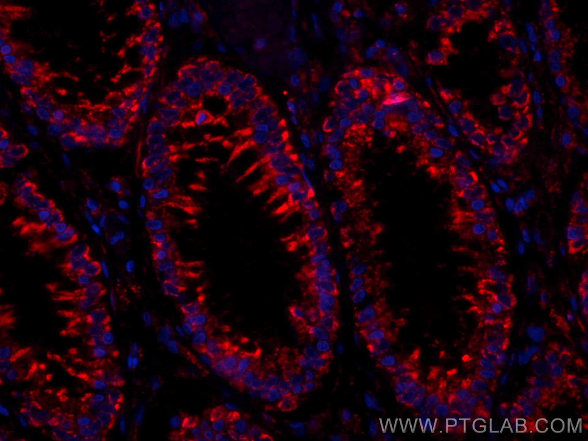 IF Staining of human colon cancer using CL594-66869