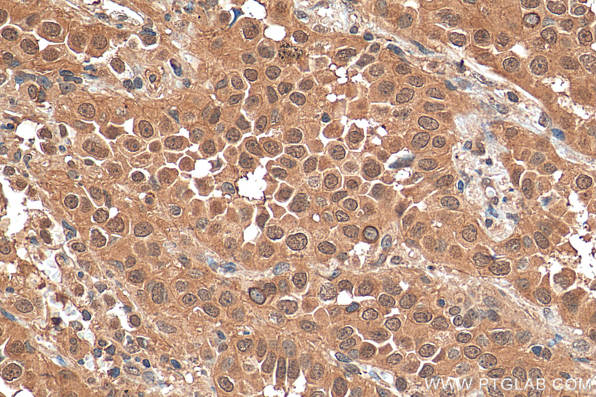 IHC staining of human lung cancer using 68089-1-Ig