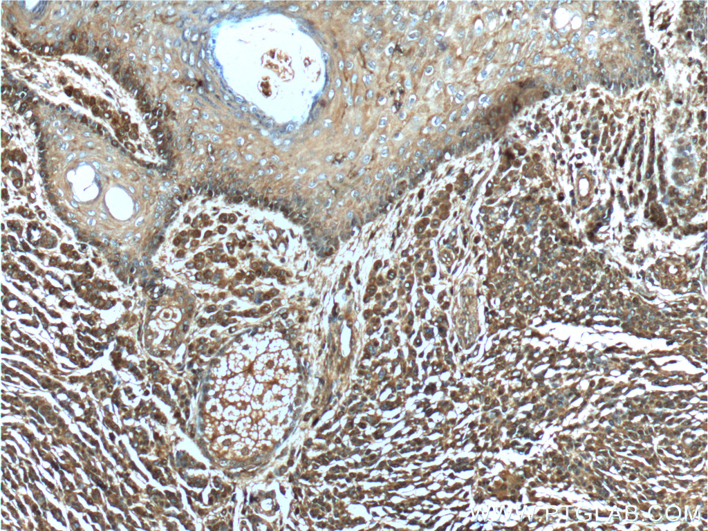 IHC staining of human malignant melanoma using 66245-1-Ig (same clone as 66245-1-PBS)
