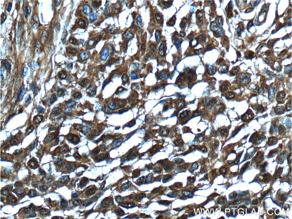 IHC staining of human malignant melanoma using 66245-1-Ig (same clone as 66245-1-PBS)