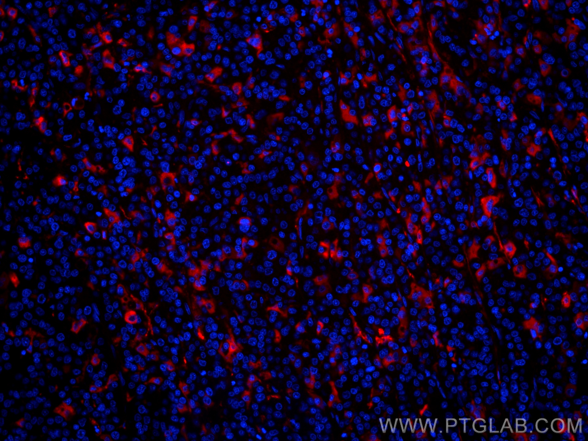 IF Staining of human liver cancer using CL594-66074