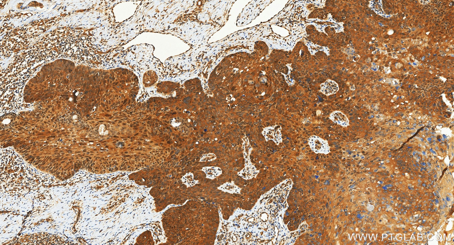 IHC staining of human bowen disease using 87817-1-RR