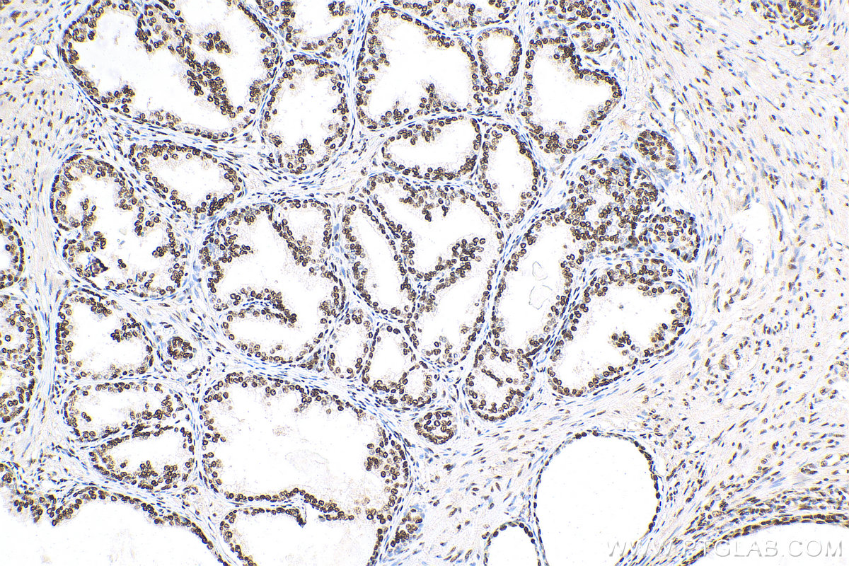 IHC staining of human prostate cancer using 82030-1-RR