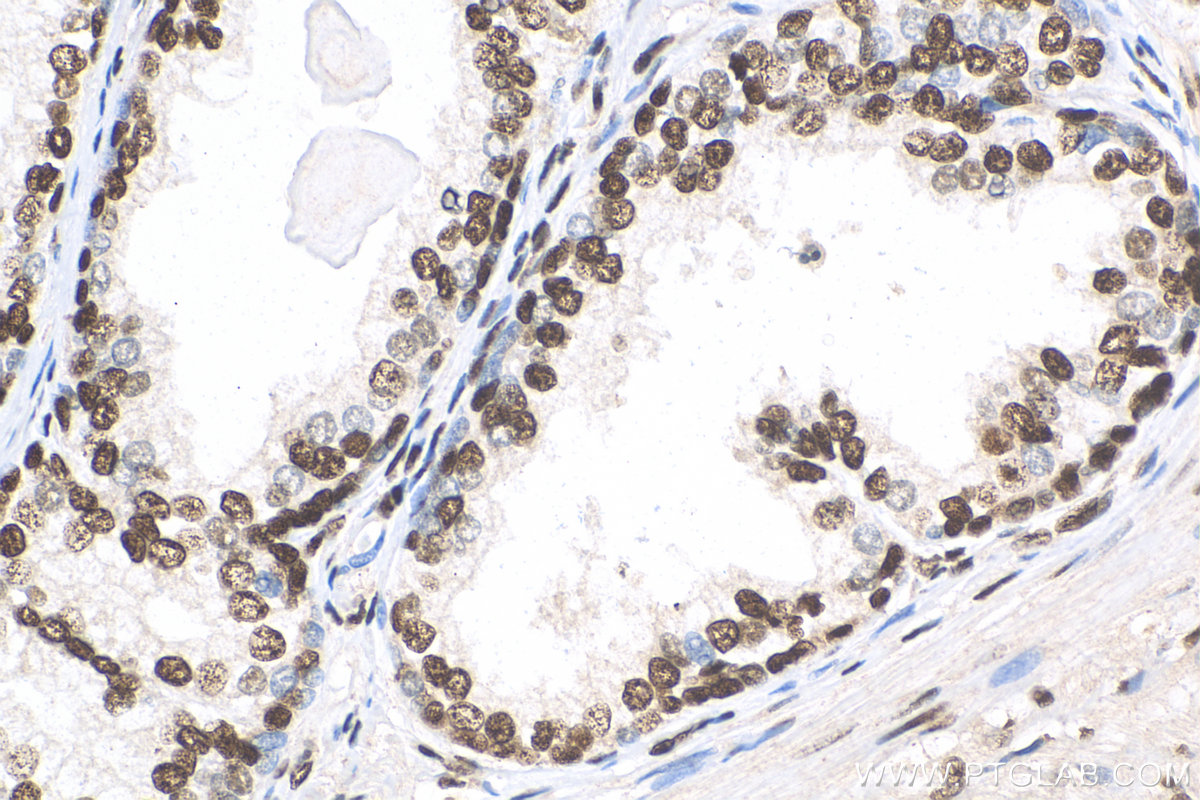 IHC staining of human prostate cancer using 82030-1-RR