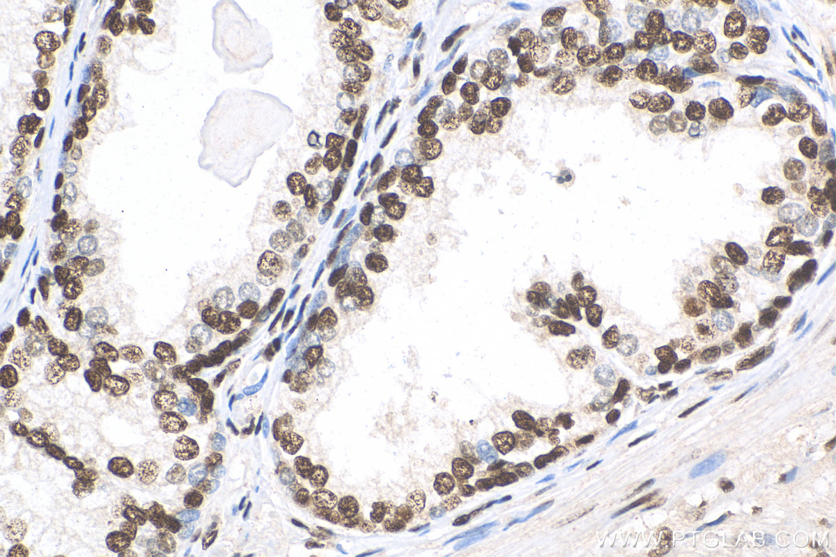 IHC staining of human prostate cancer using 82030-1-RR (same clone as 82030-1-PBS)