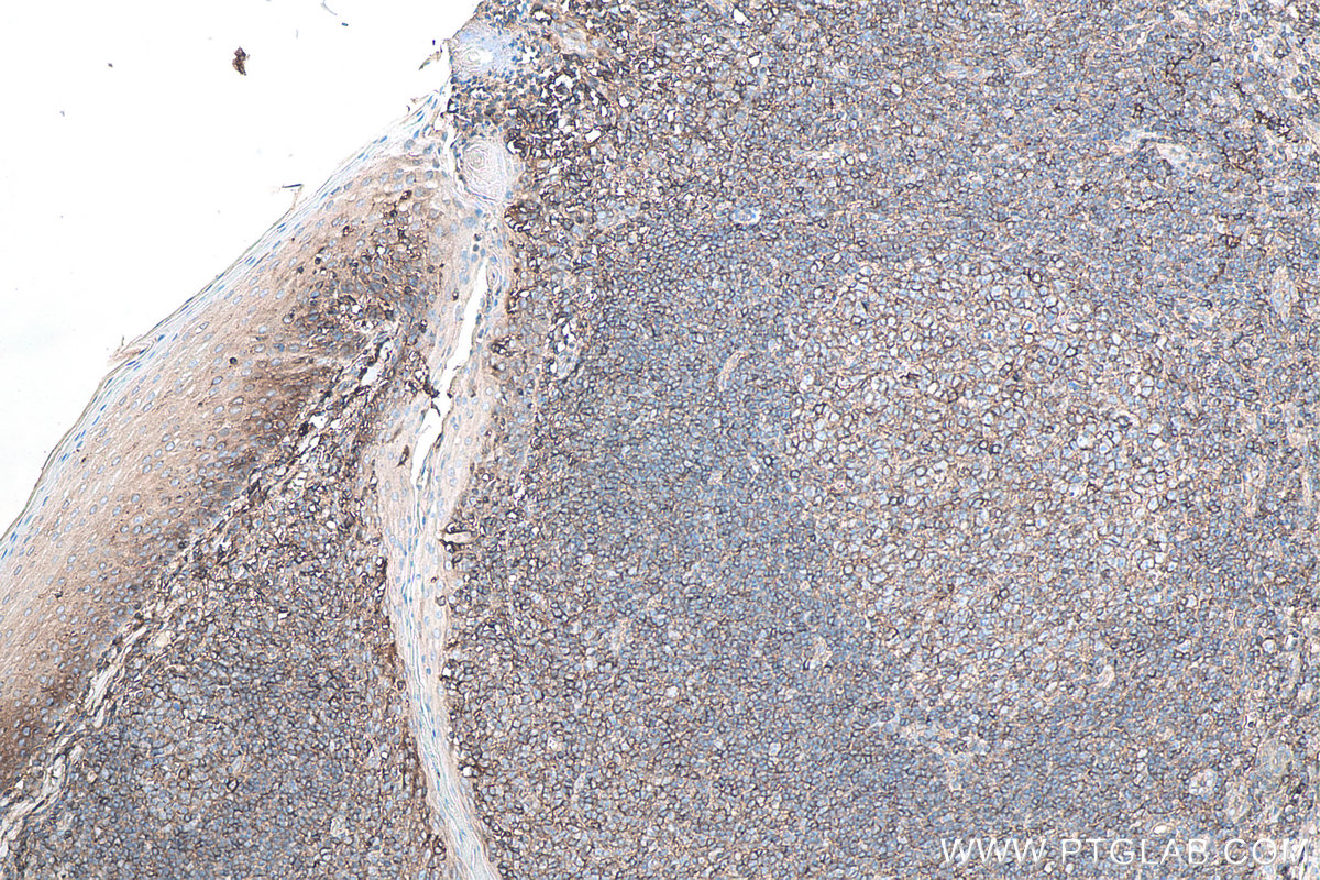 IHC staining of human tonsillitis using 13511-1-AP