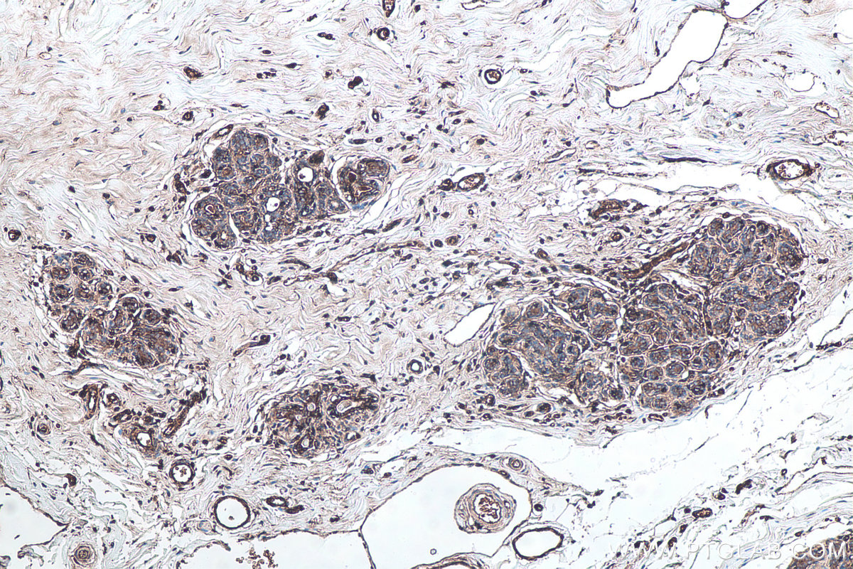 IHC staining of human breast cancer using 13511-1-AP