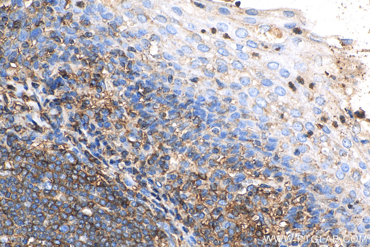 IHC staining of human tonsillitis using 13511-1-AP