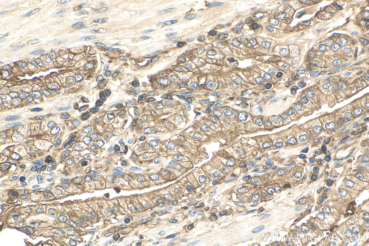 IHC staining of human prostate cancer using 66207-1-Ig