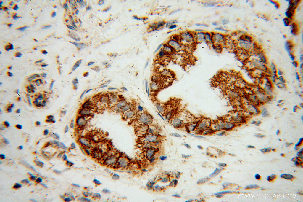 IHC staining of human pancreas cancer using 13490-1-AP