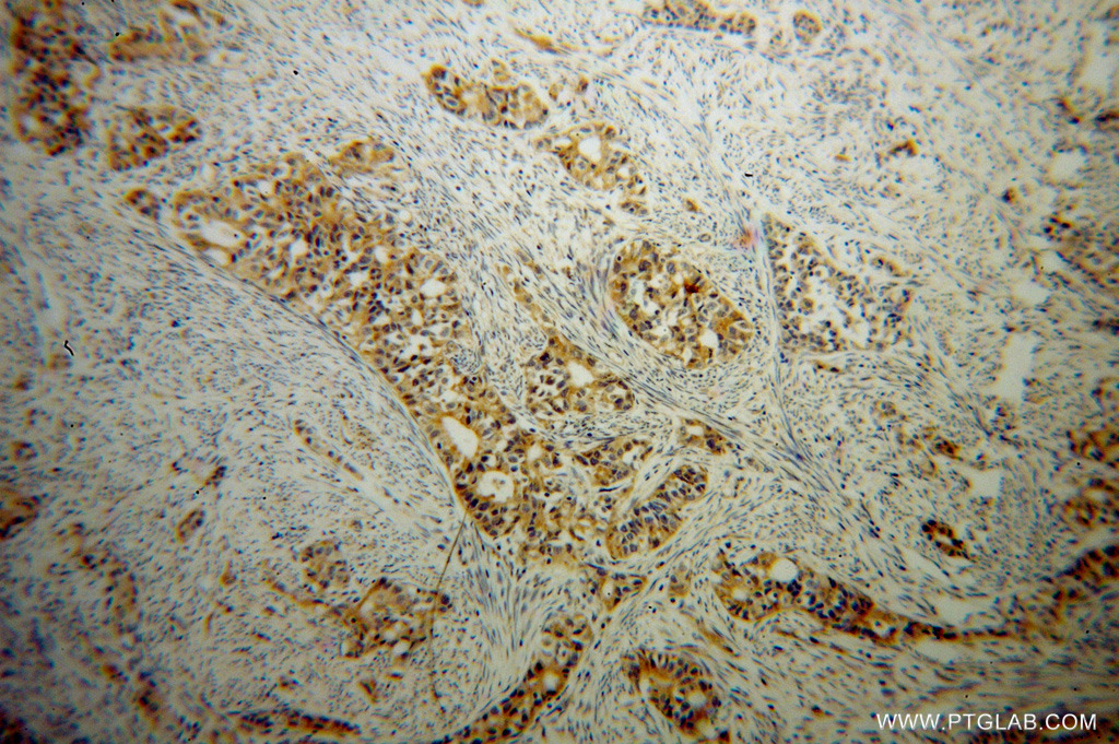 IHC staining of human endometrial cancer using 14601-1-AP