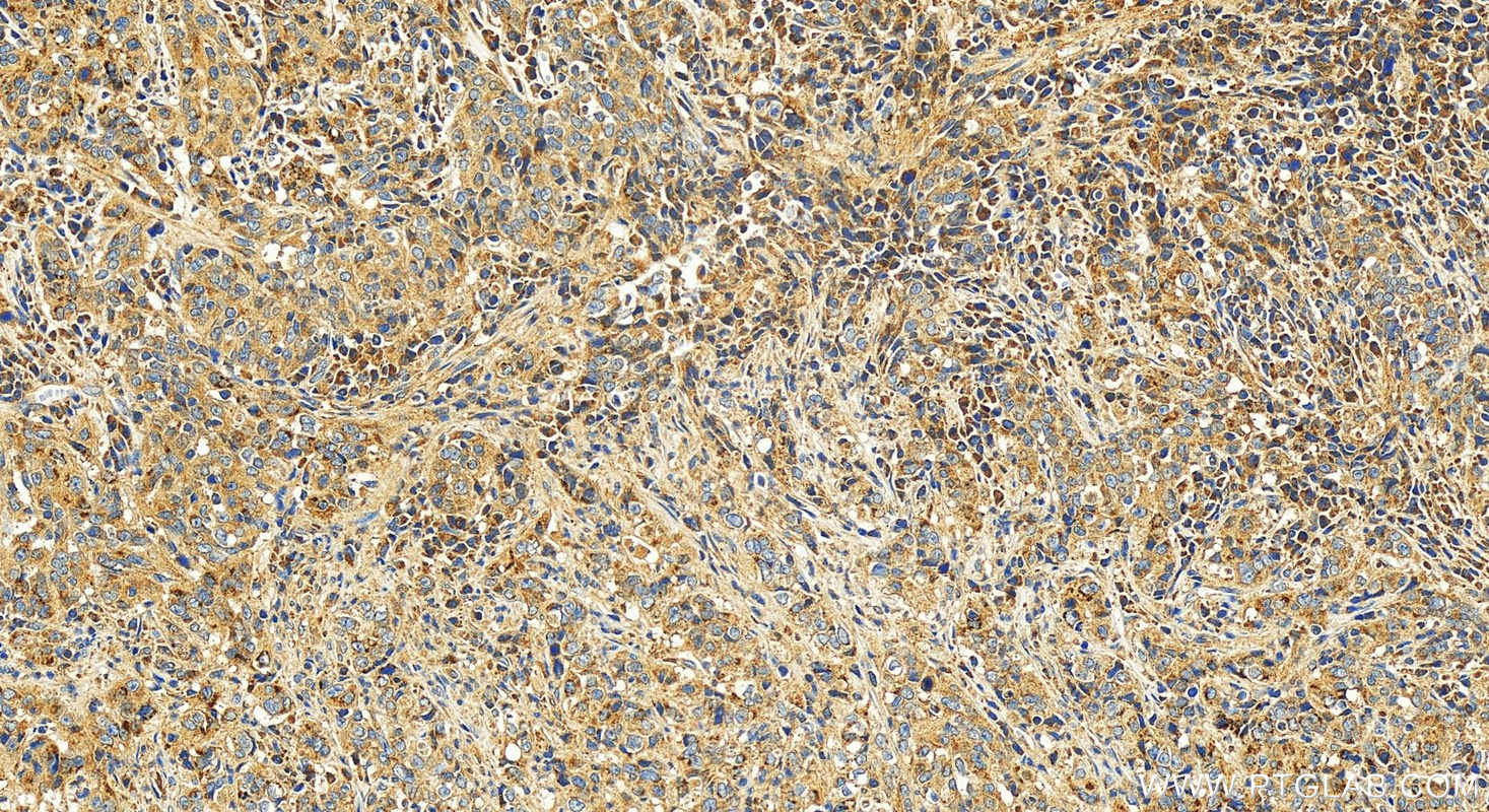 IHC staining of human stomach cancer using 21291-1-AP