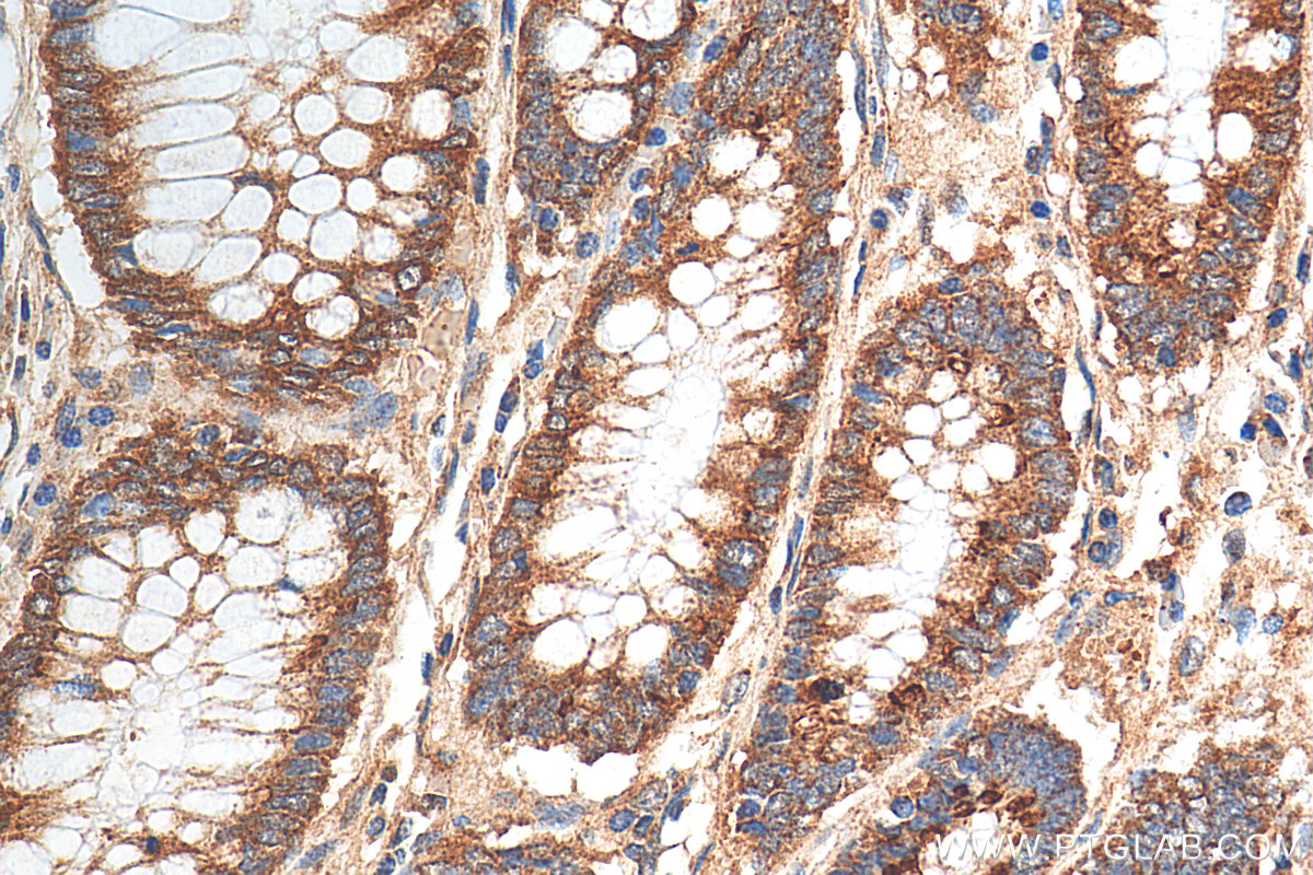 IHC staining of human colon cancer using 21291-1-AP