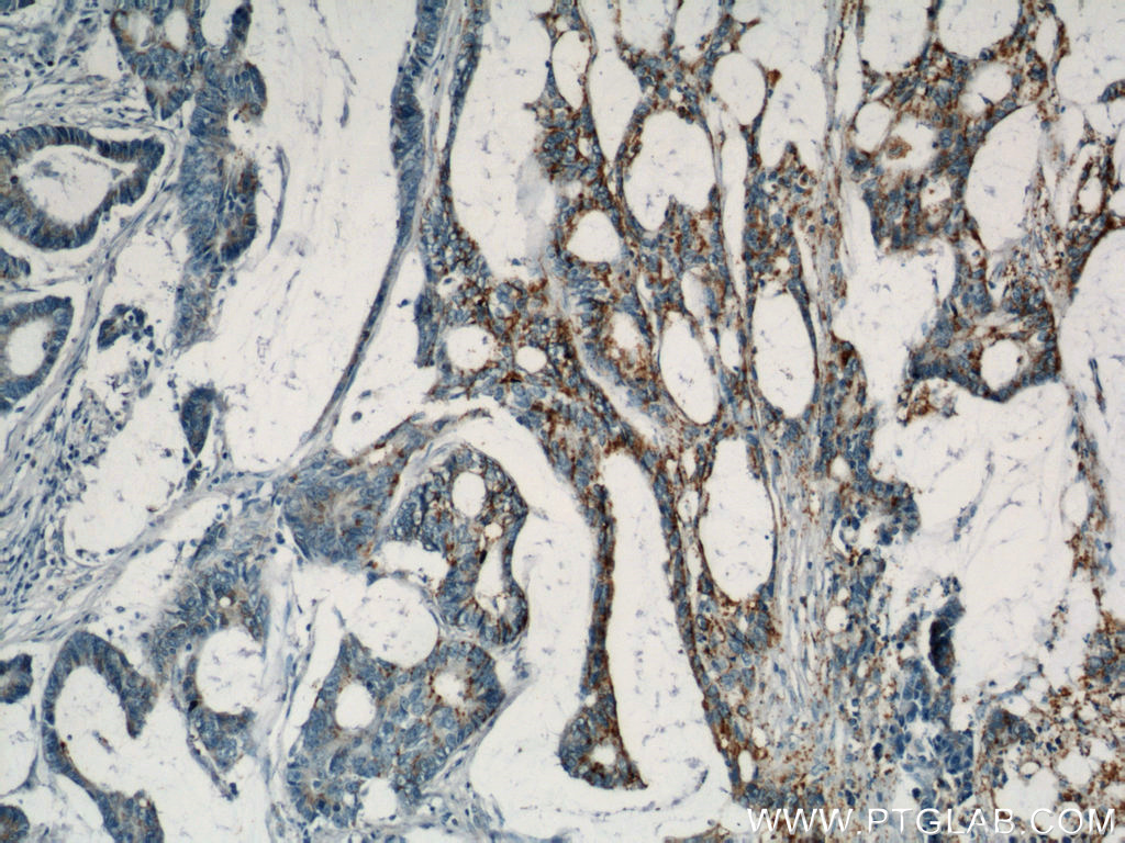 IHC staining of human colon cancer using 20330-1-AP