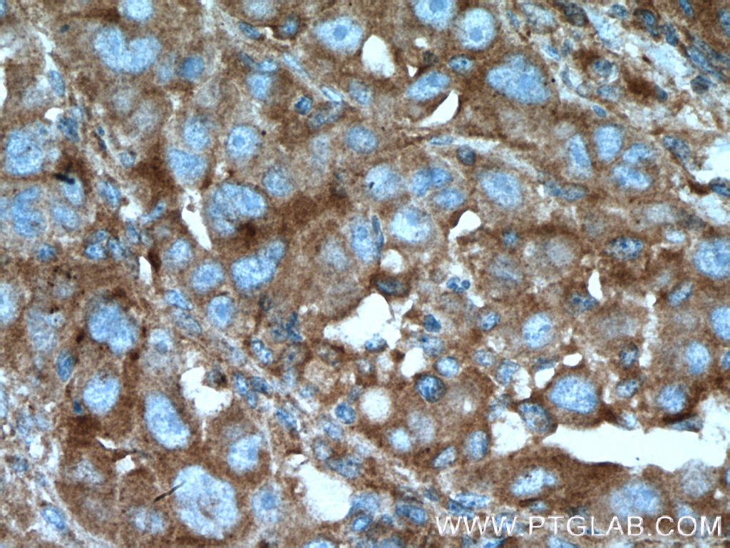 IHC staining of human liver cancer using 11041-1-AP