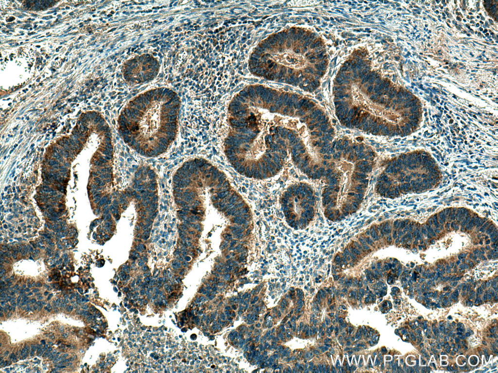 IHC staining of human colon cancer using 22058-1-AP