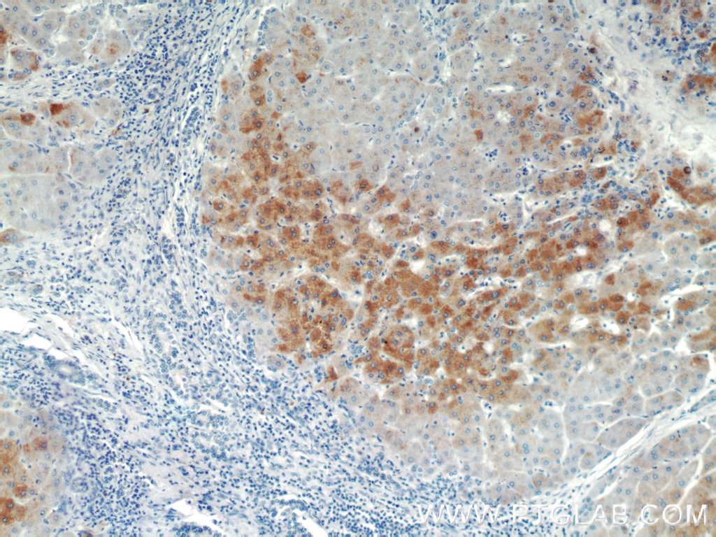 IHC staining of human hepatocirrhosis using 15990-1-AP