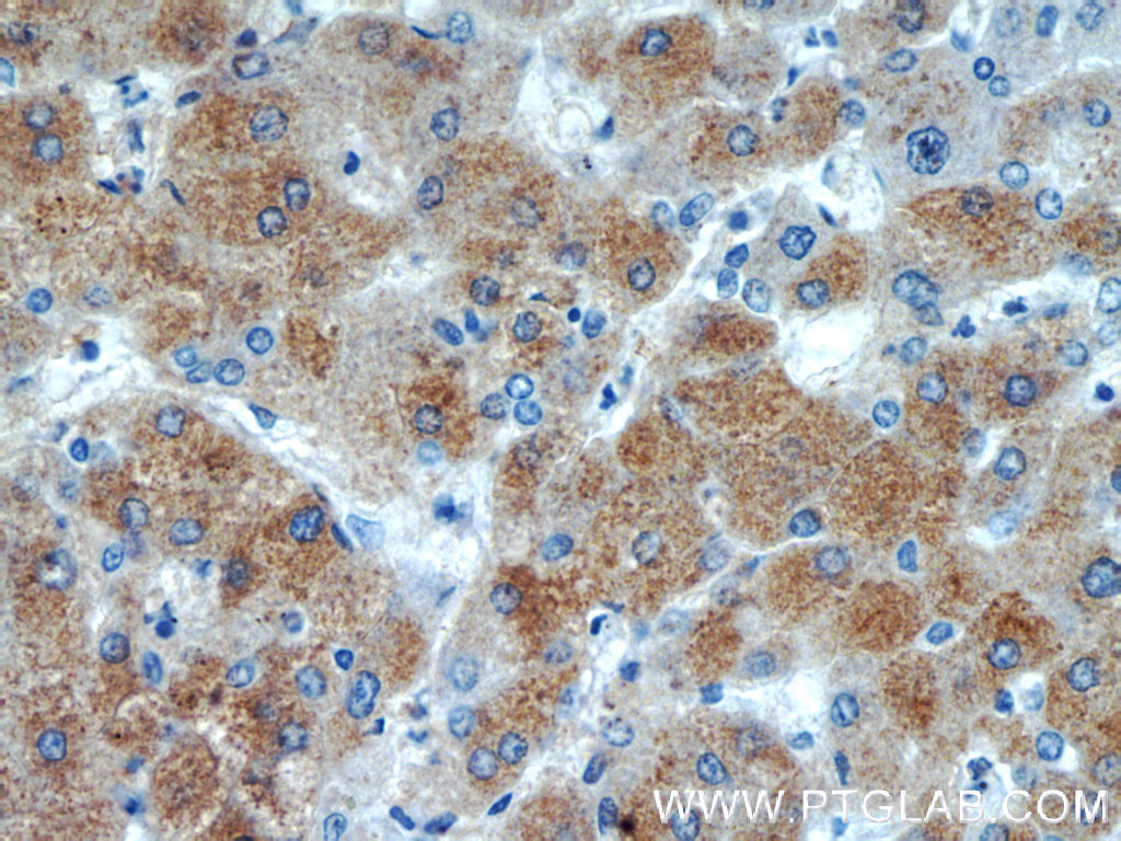 IHC staining of human hepatocirrhosis using 15990-1-AP