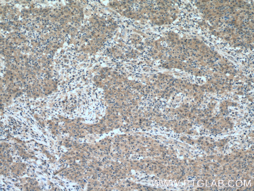 IHC staining of human colon cancer using 16321-1-AP