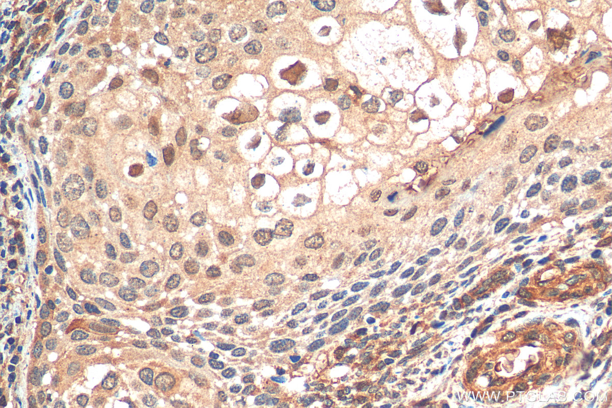 IHC staining of human cervical cancer using 14018-1-AP