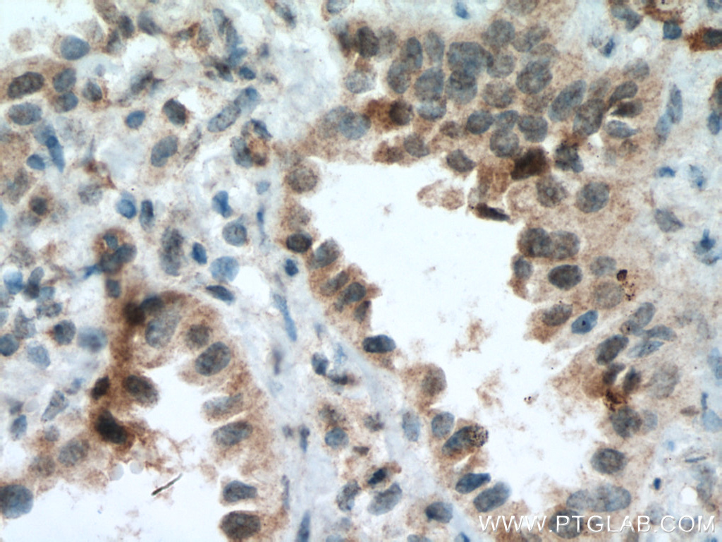 IHC staining of human lung cancer using 66762-1-Ig