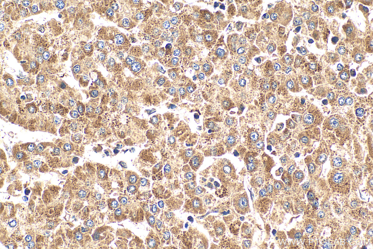 IHC staining of human liver cancer using 19789-1-AP