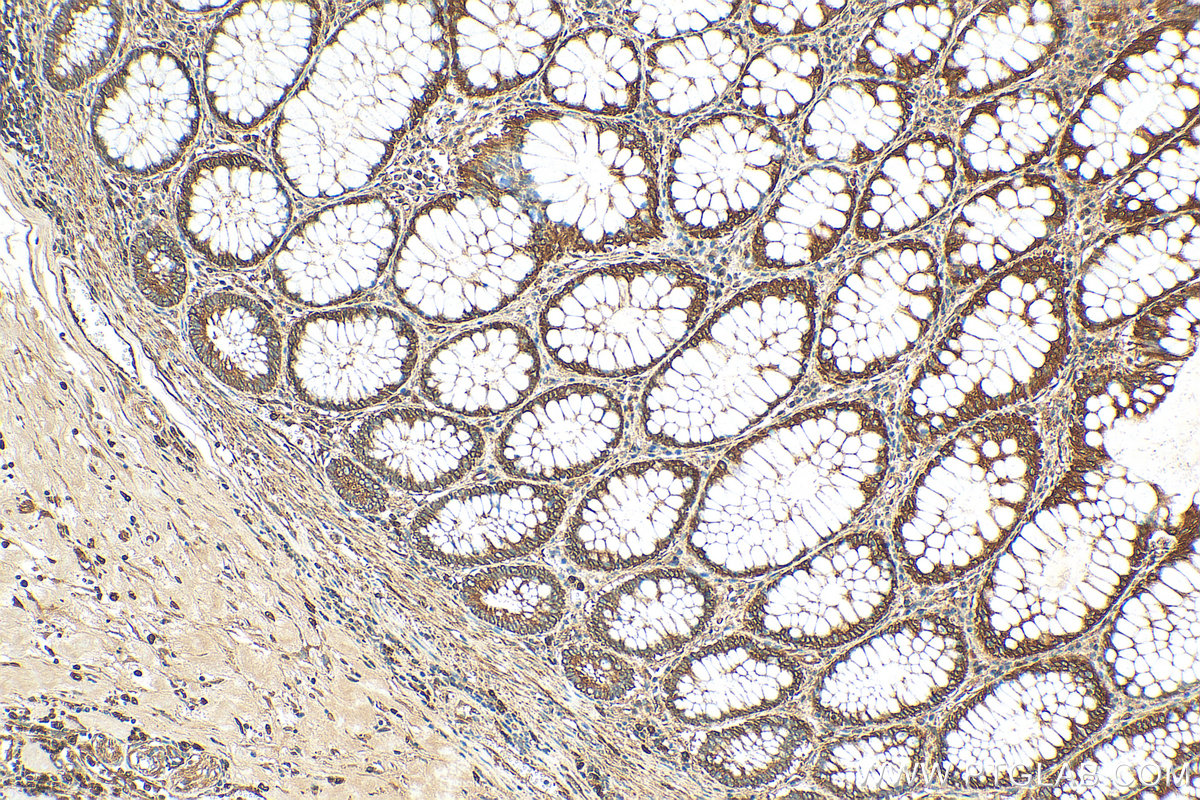 IHC staining of human colon cancer using 29552-1-AP