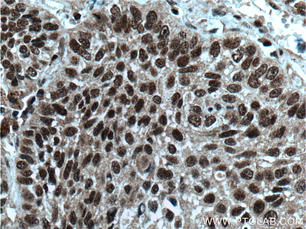 IHC staining of human lung cancer using 16393-1-AP