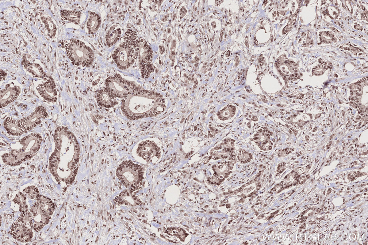 IHC staining of human rectal cancer using 16393-1-AP
