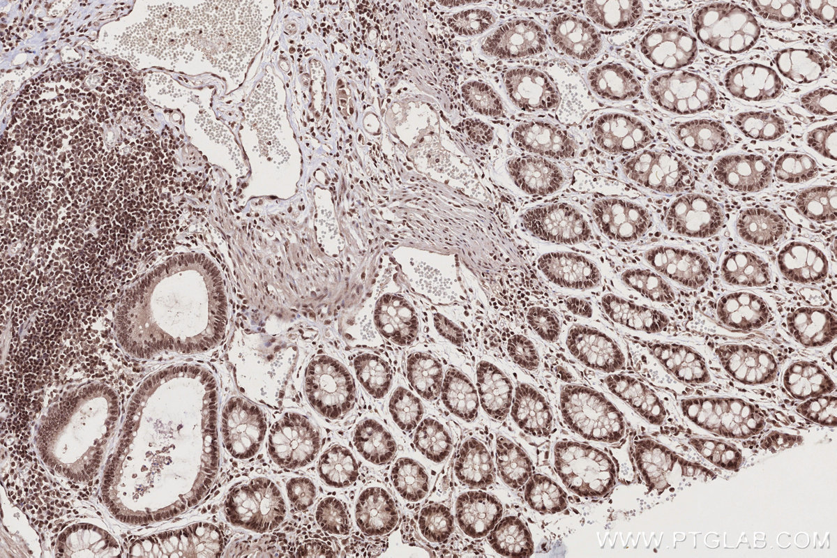 IHC staining of human rectal cancer using 16393-1-AP