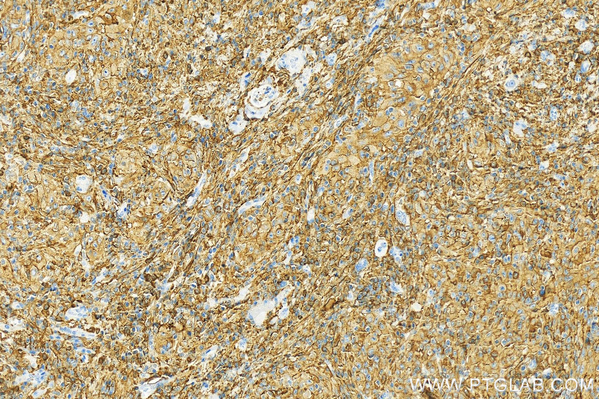 IHC staining of human skin cancer using 14880-1-AP