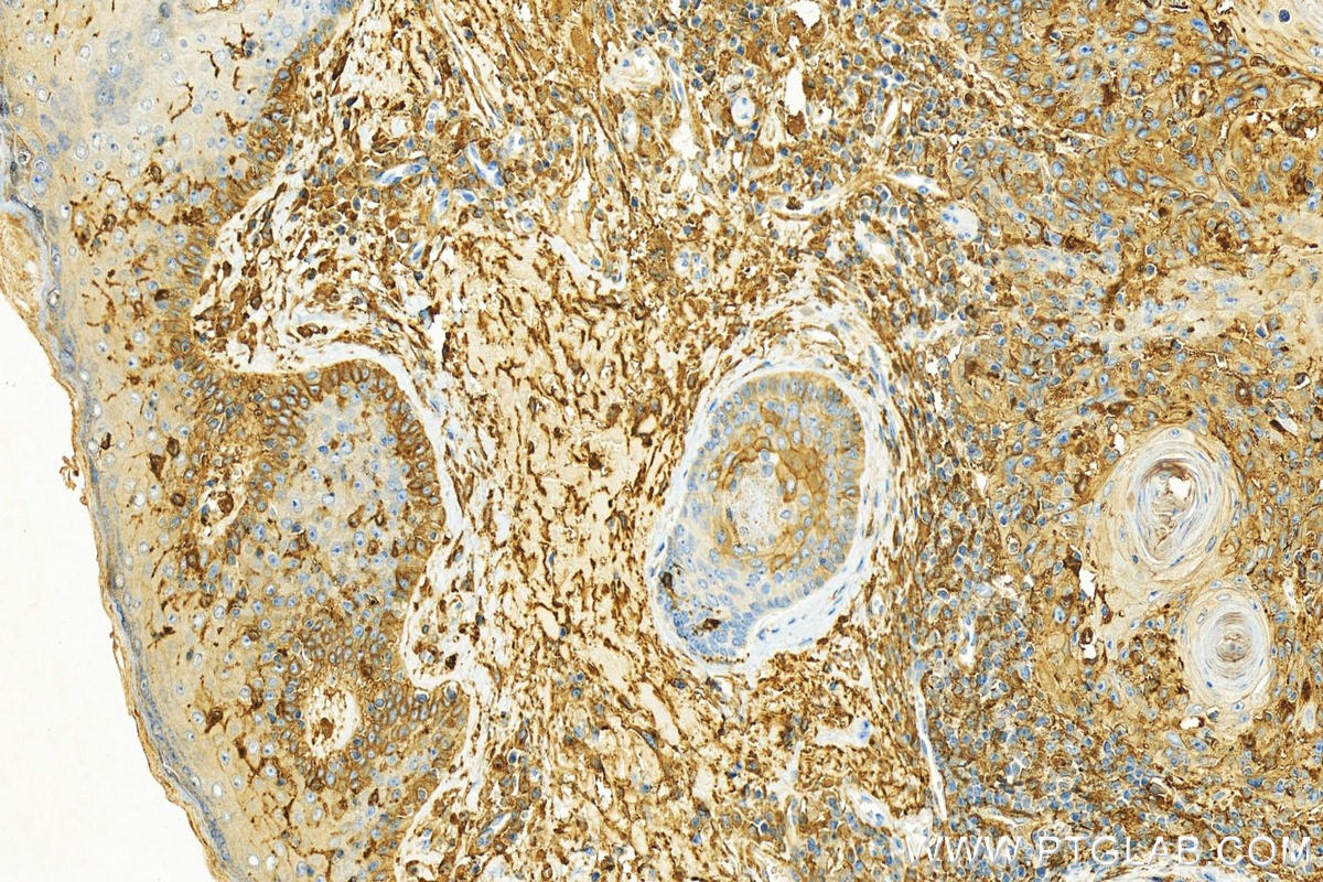 IHC staining of human skin cancer using 14880-1-AP