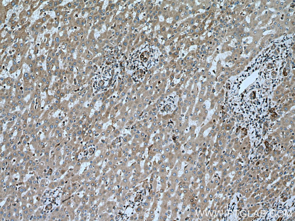 IHC staining of human liver cancer using 60267-1-Ig (same clone as 60267-1-PBS)
