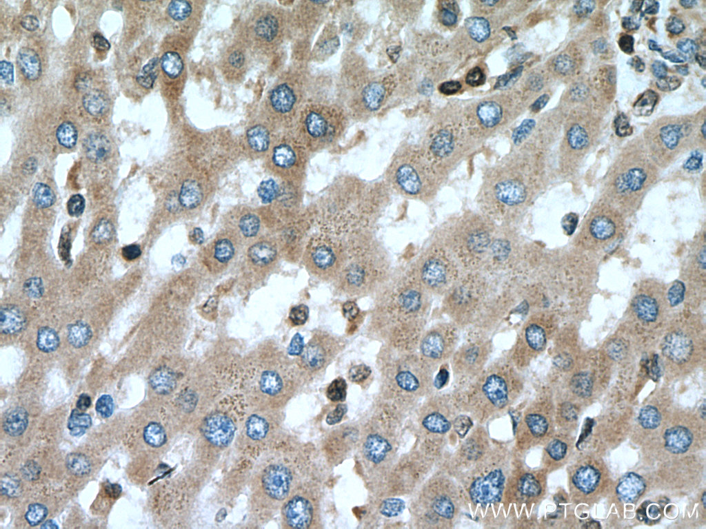 IHC staining of human liver cancer using 60267-1-Ig (same clone as 60267-1-PBS)