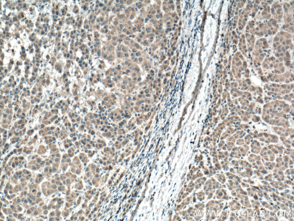 IHC staining of human liver cancer using 66679-1-Ig