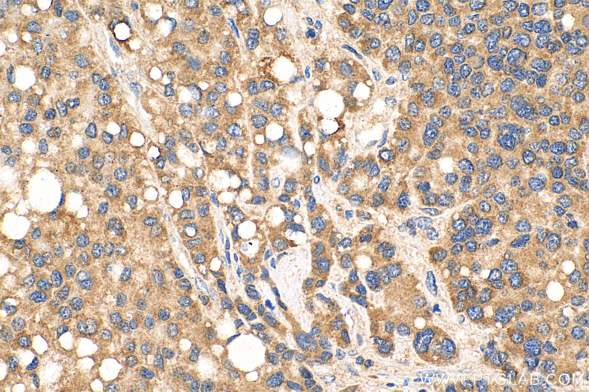 IHC staining of human liver cancer using 16206-1-AP