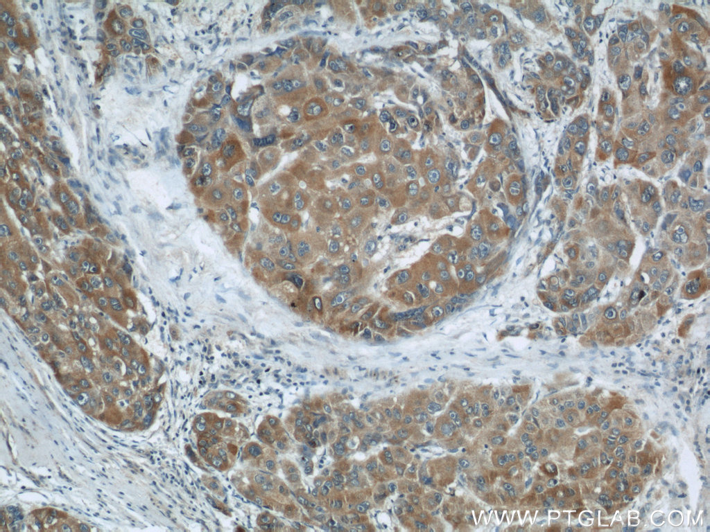IHC staining of human liver cancer using 16206-1-AP