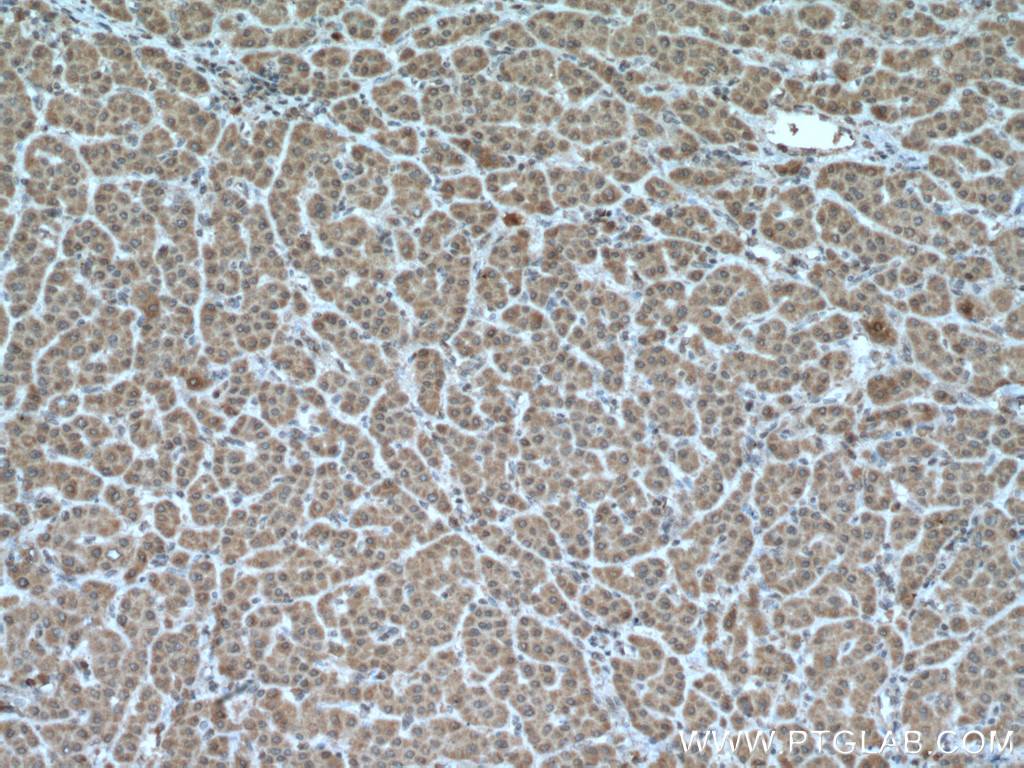 IHC staining of human liver cancer using 66518-1-Ig (same clone as 66518-1-PBS)