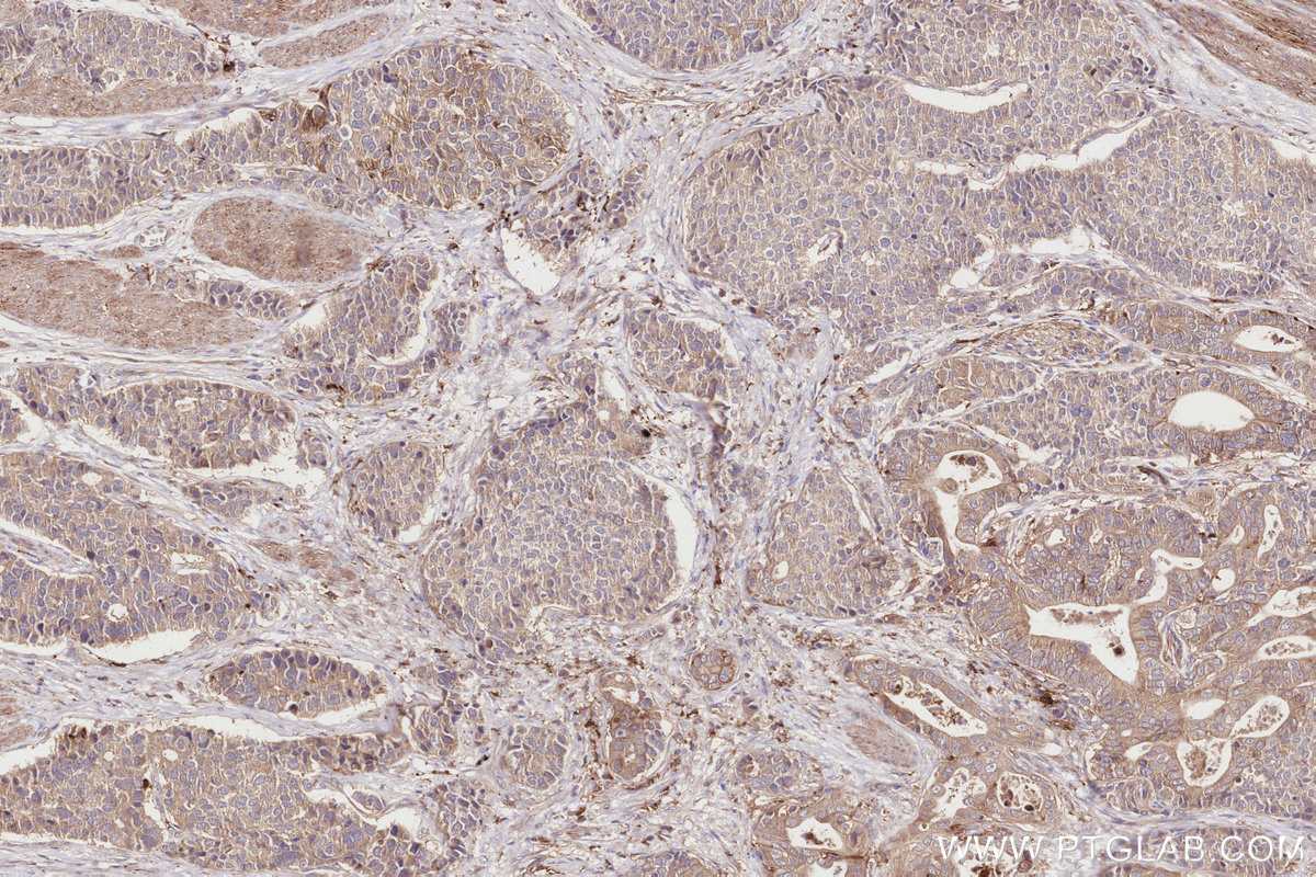 IHC staining of human stomach cancer using 82961-1-RR IHC staining of human stomach cancer using 82961-1-RR
