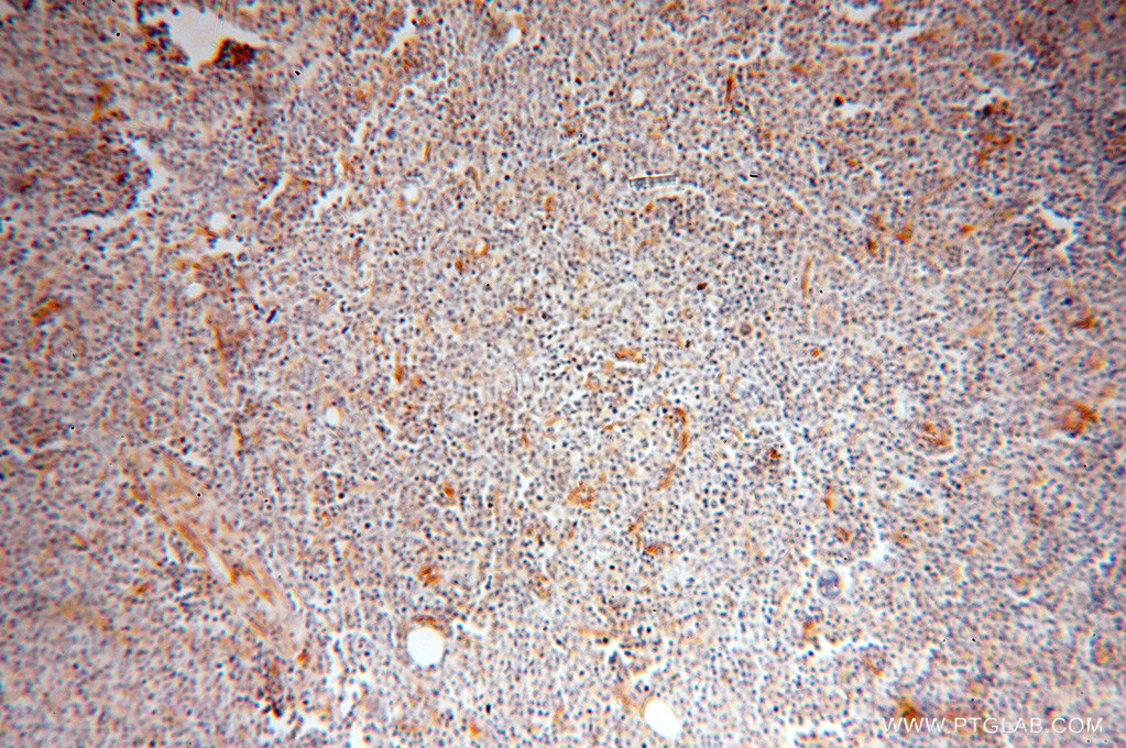 IHC staining of human lymphoma using 15796-1-AP