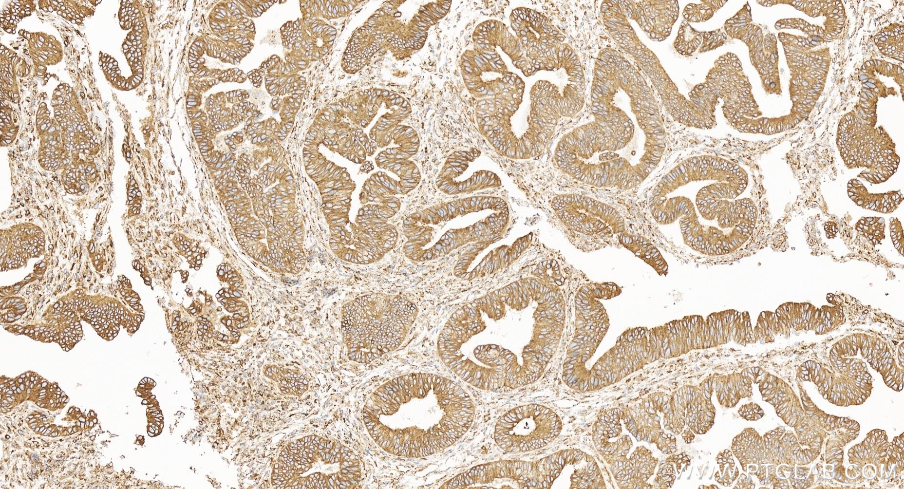 IHC staining of human colon cancer using 84584-5-RR