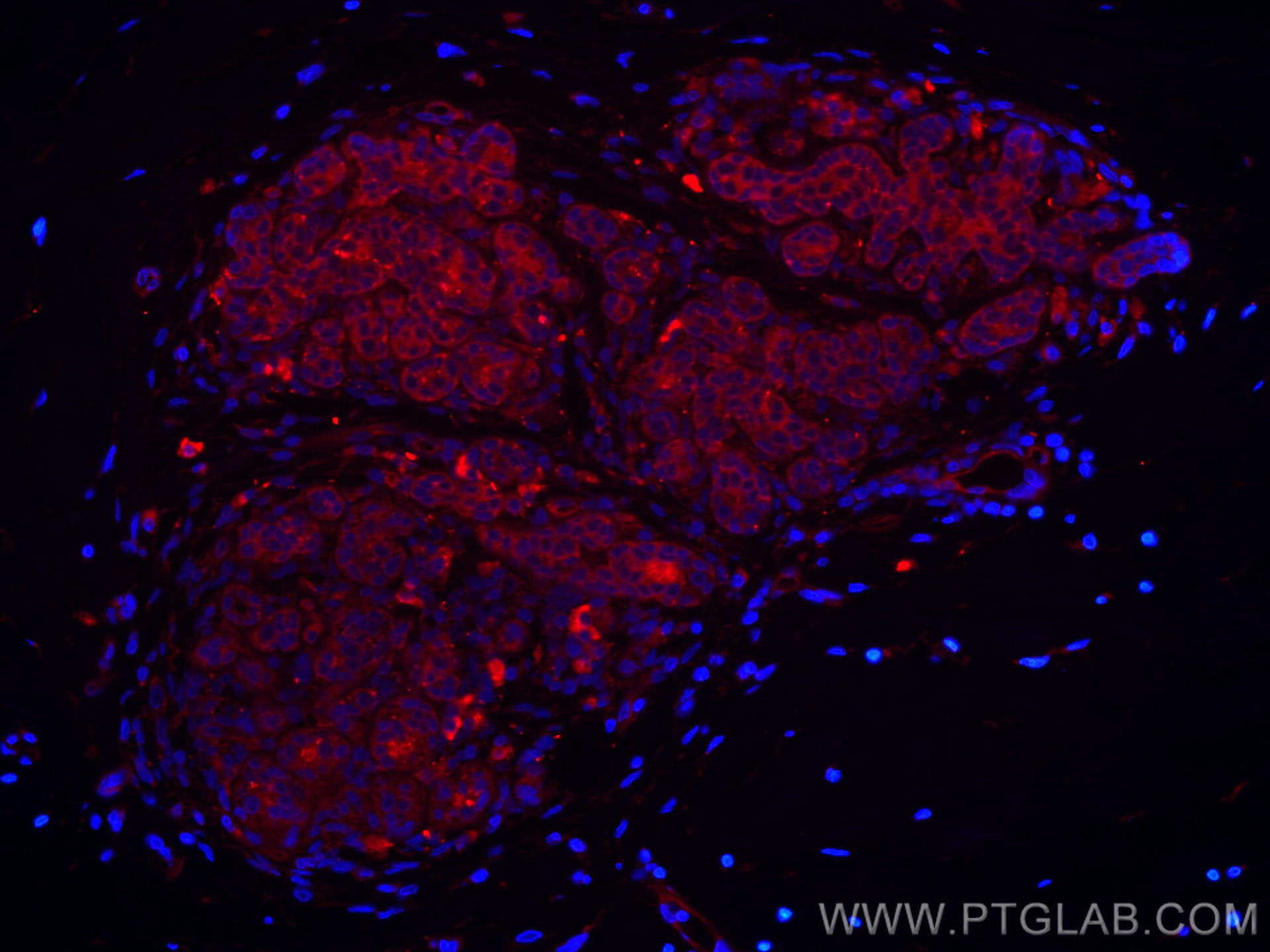 IF Staining of human breast cancer using CL594-67215