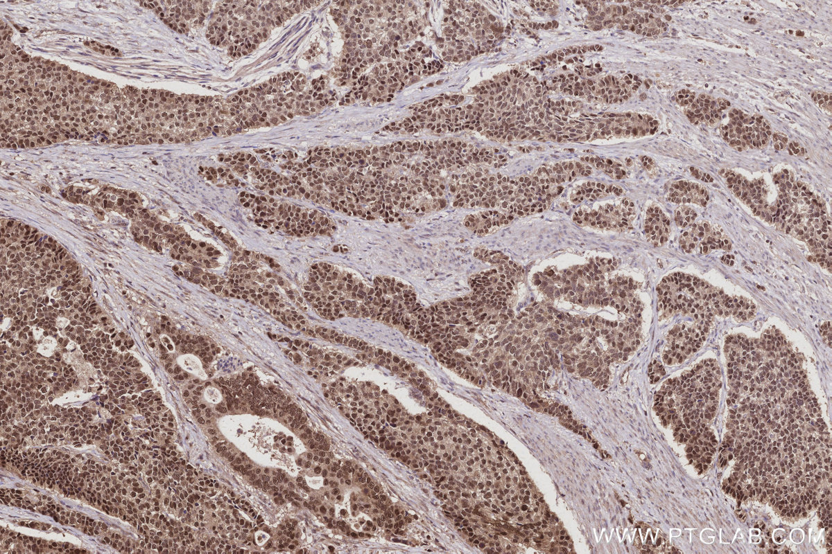 IHC staining of human stomach cancer using 16043-1-AP IHC staining of human stomach cancer using 16043-1-AP