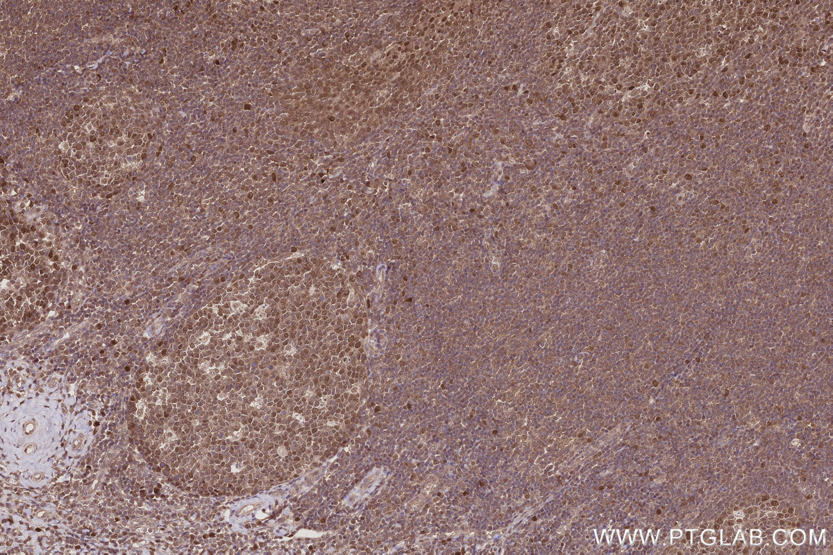IHC staining of human tonsillitis using 16043-1-AP IHC staining of human tonsillitis using 16043-1-AP