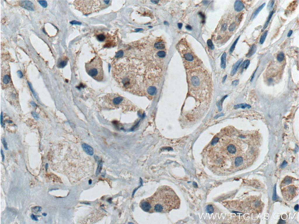 IHC staining of human breast cancer using 17732-1-AP