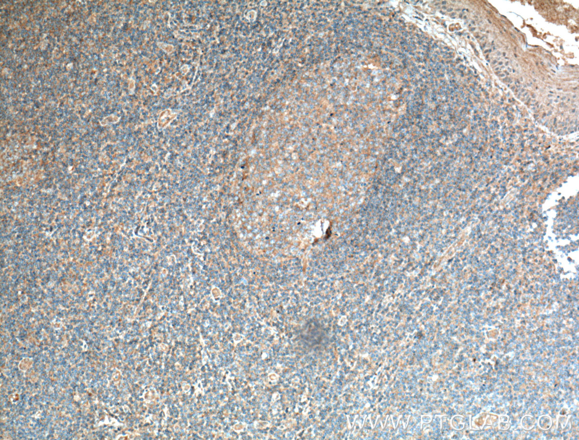IHC staining of human tonsillitis using 66556-1-Ig (same clone as 66556-1-PBS)