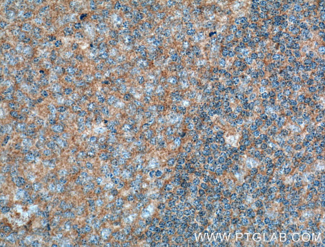 IHC staining of human tonsillitis using 66556-1-Ig (same clone as 66556-1-PBS)