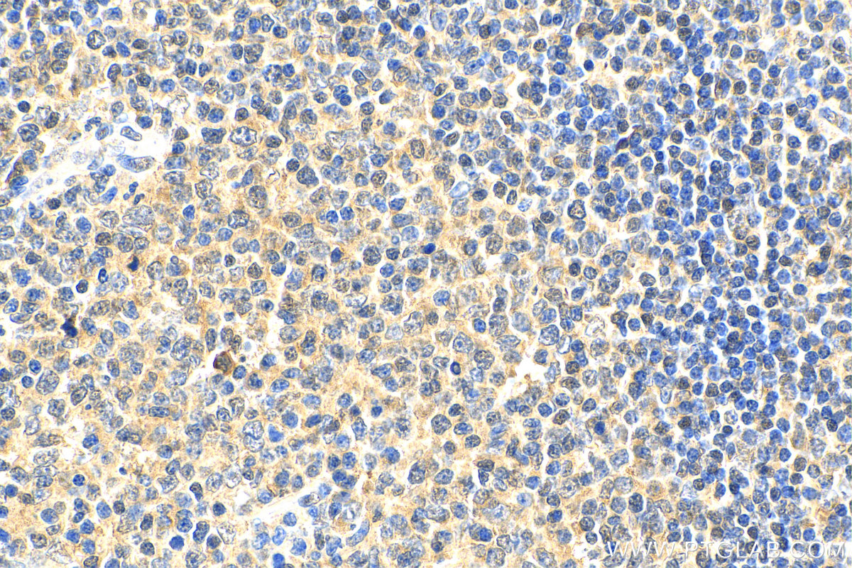 IHC staining of human tonsillitis using 11613-1-AP